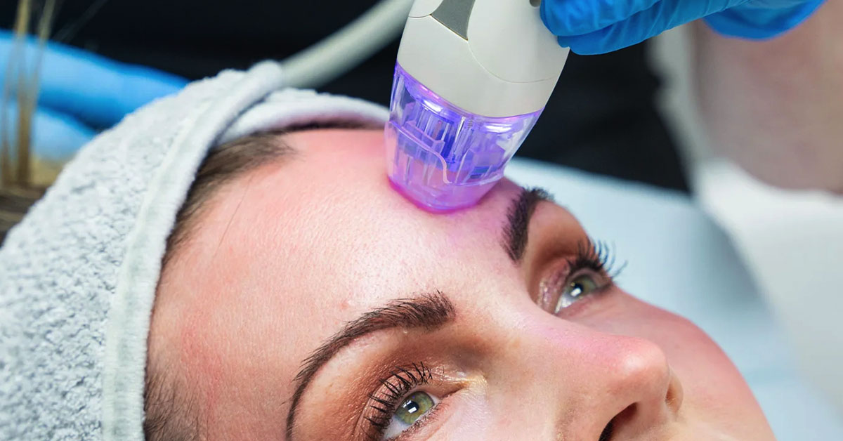 Microneedling Microneedling